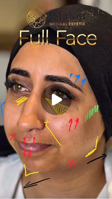 Göz Altı Işık Dolgusu